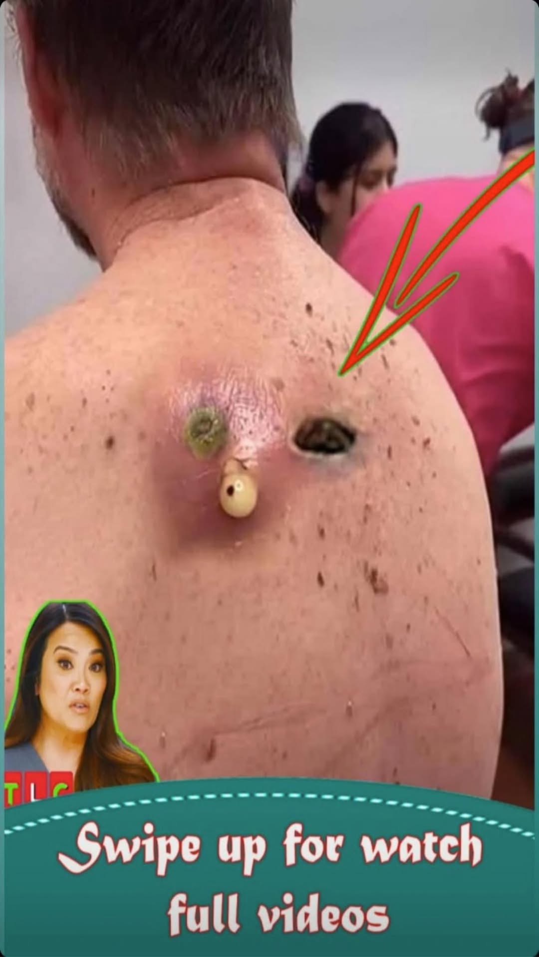 Acne And Everything You Need To Know About Them