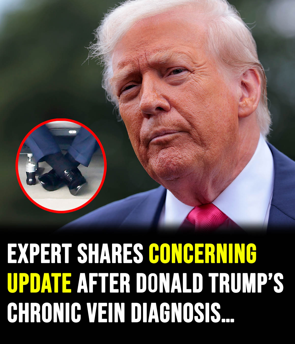 Donald Trump diagnosed with chronic venous insufficiency following leg swelling