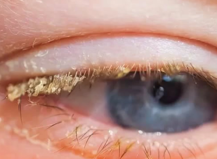 Why You Wake Up with Gunk in Your Eyes