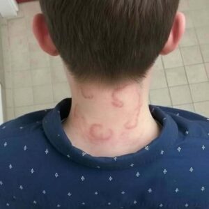 How to identify and cure skin fungus or rin