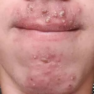 Been dating this woman I met at Walmart and after finally getting some I woke up with these on my face what is this?