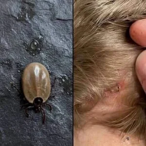Found a Tick on Your Child? Here’s What Parents Should Do—and What to Watch For